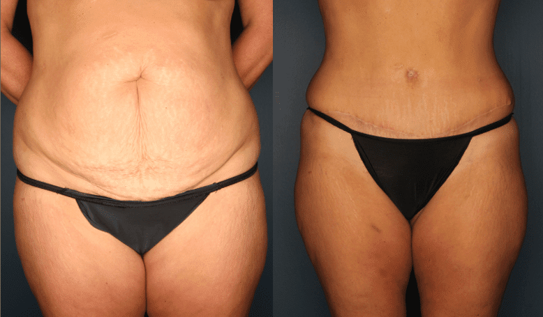 Achieve a Contoured and Youthful Midsection with a Belt Lipectomy