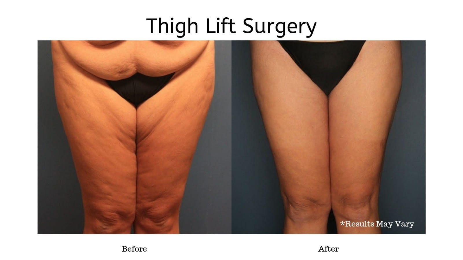 Get Beautiful Legs With (Or Without) Surgery