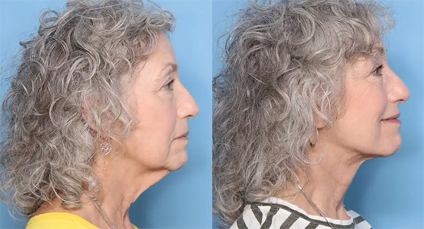 Before and After Neck lift patient photo