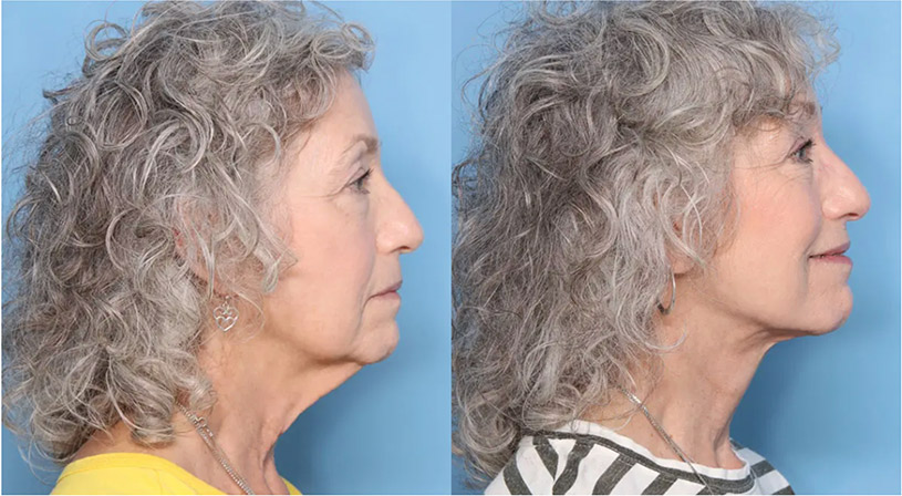 before and after images of a neck lift patient.