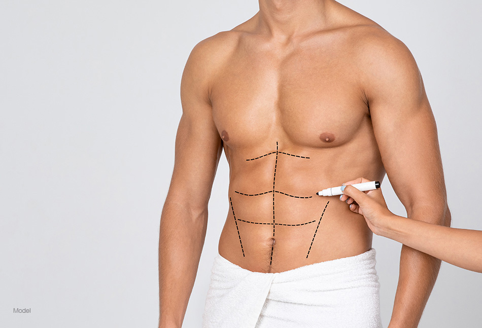 A man's fit torso with surgical lines outline his abdominal muscles.