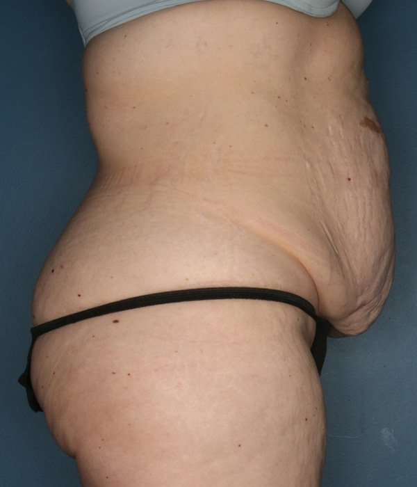 Tummy Tuck Scar After 3 Years