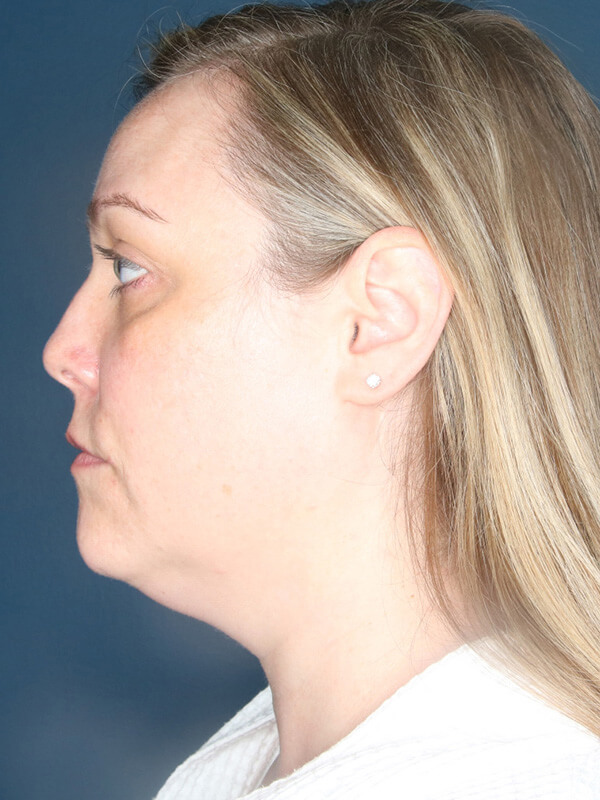 Before And After Submental Liposuction Neck Liposuction Gallery