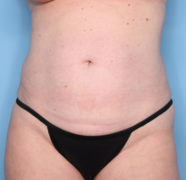 Liposuction Before & After Gallery: Patient 12