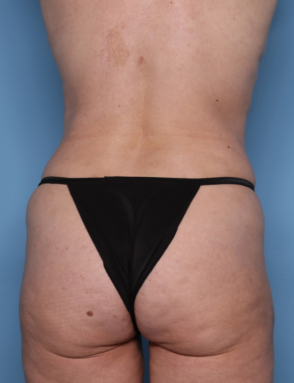 Bra Line Back Lift Before & After Photos Patient 112